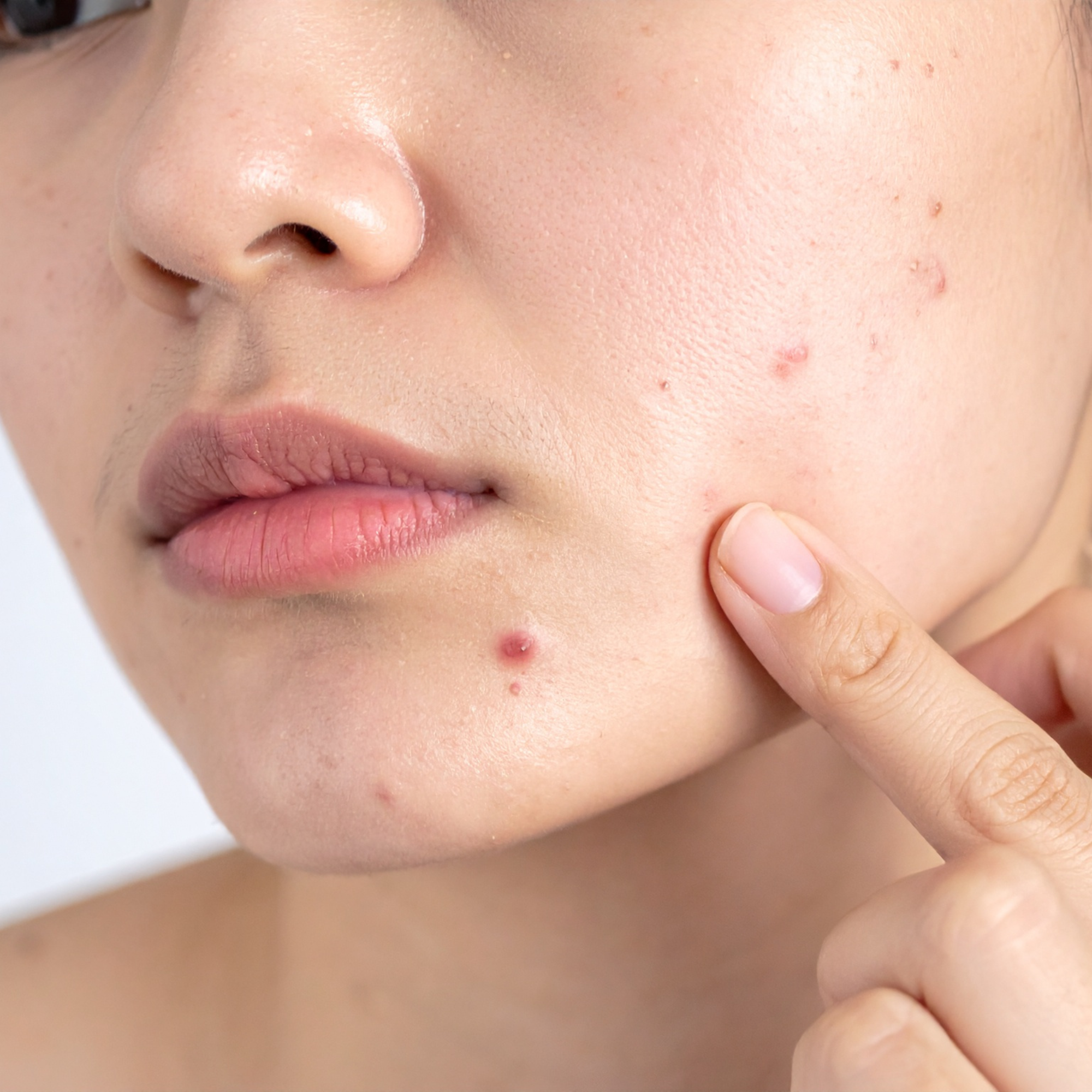 Hormonal Acne and Diet